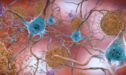 Thuốc mới điều trị bệnh Alzheimer giai đoạn đầu làm tăng hy vọng về phương pháp điều trị tốt hơn