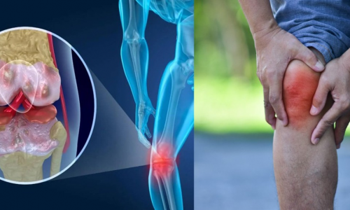 Mùa Đông: Người cao tuổi thường hay đau khớp gối - Nên làm gì để phòng ngừa và điều trị cho bớt lo lắng?