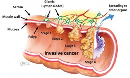 Tuổi nào nên đi xét ngiệm ung thư ruột ?
