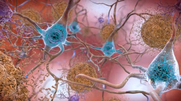 Thuốc mới điều trị bệnh Alzheimer giai đoạn đầu làm tăng hy vọng về phương pháp điều trị tốt hơn