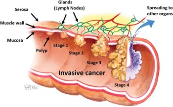 Tuổi nào nên đi xét ngiệm ung thư ruột ?