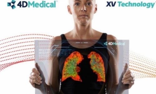 Úc trang bị thiết bị chụp phổi 4 chiều (4D) đầu tiên trên thế giới