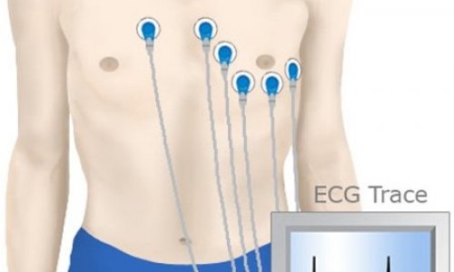 Mỗi ngày có khoảng 120 người Úc tử vong vì bệnh tim mạch - Tại sao nên chạy Điện Tâm Đồ (ECG) ngay khi còn trẻ?