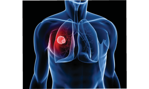 Ung thư phổi tại Úc: - Mỗi năm 15,500 người được chẩn đoán mắc bệnh, gần 9,000 ca tử vong.