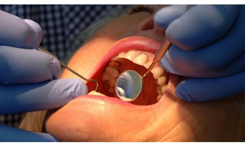 Các khoa học gia 'háo hức' với gel phục hồi men răng