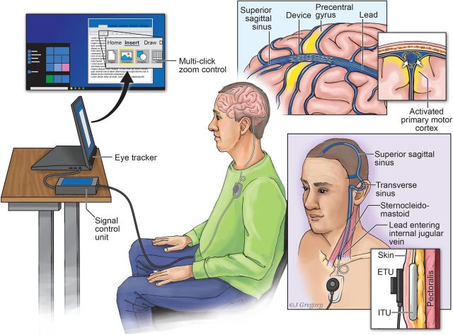 Kết nối não người với máy tính qua… mạch máu