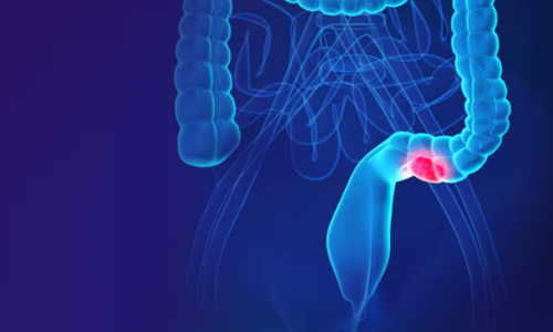 Sức khỏe là Vàng: Từ polyp đến ung thư – bác sĩ cảnh báo điều nhiều người trẻ đang bỏ qua