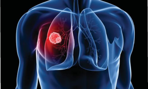 Ung thư phổi tại Úc: - Mỗi năm 15,500 người được chẩn đoán mắc bệnh, gần 9,000 ca tử vong.