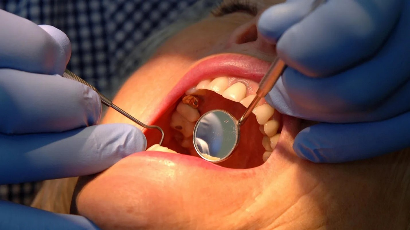 Các khoa học gia 'háo hức' với gel phục hồi men răng